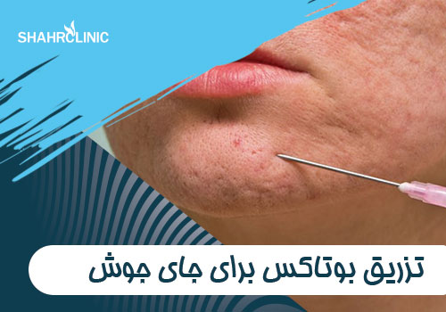 تزریق بوتاکس برای جای جوش