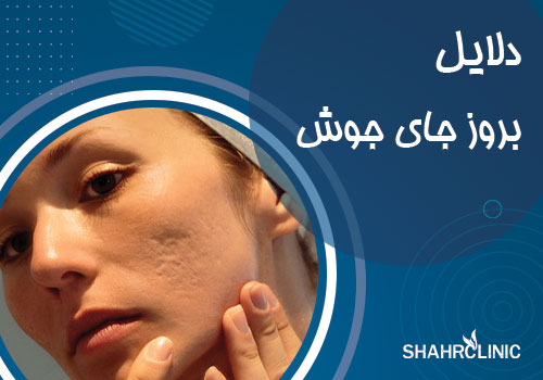 دلایل بروز جای جوش