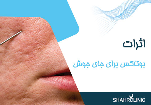 اثرات بوتاکس برای جای جوش
