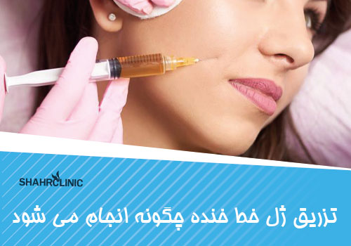 تزریق ژل به خط خنده چگونه انجام میشود؟