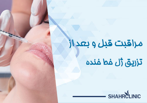 مراقبتهای قبل و بعد از تزریق ژل خط خنده چگونه است؟