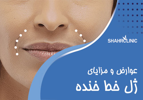 مزایای تزریق ژل برای درمان خط خنده