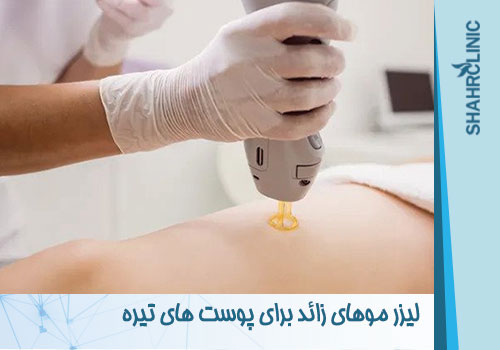 لیزر موهای زائد برای پوست های تیره