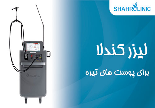 لیزر کندلا برای پوست های تیره