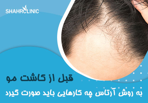 قبل از کاشت مو به روش artist چه کارهایی باید صورت گیرد؟
