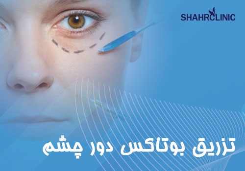بوتاکس دور چشم