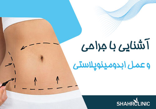 عمل ابدومینوپلاستی