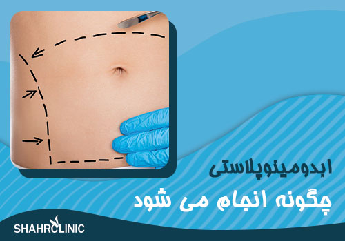 جراحی ابدومینوپلاستی چگونه انجام می شود؟
