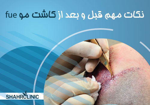 نکات مهم قبل از انجام کاشت مو FUE