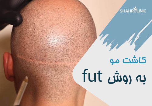 آشنایی با روش کاشت مو به روش FUT
