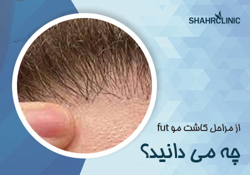 از مراحل کاشت مو به روش FUT چه می دانید؟