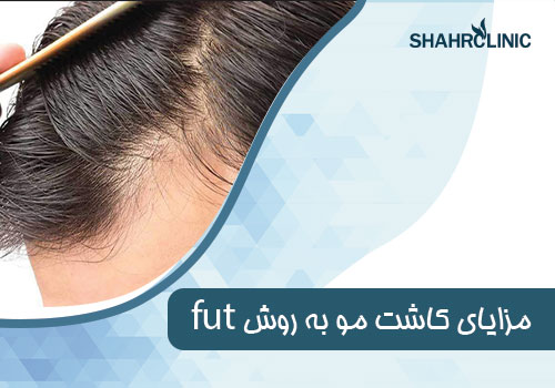 کاشت مو به روش اف یو تی برای چه کسانی مناسب است؟