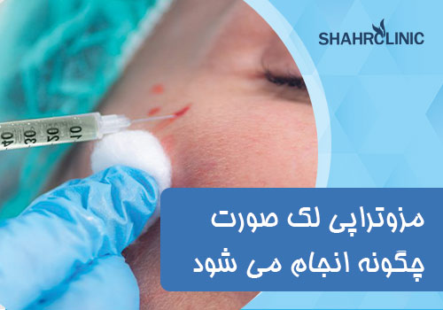 مزوتراپی لک صورت چگونه انجام می شود؟