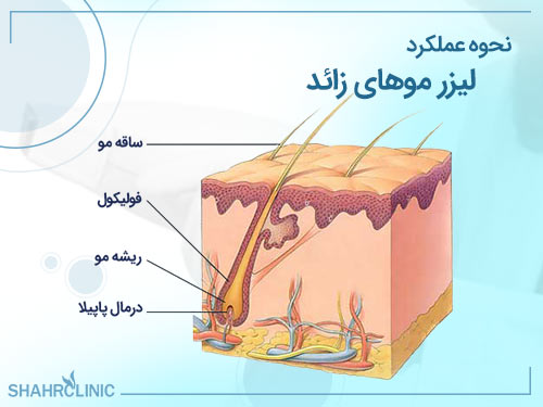 نحوه عملکرد لیزر موهای زائد