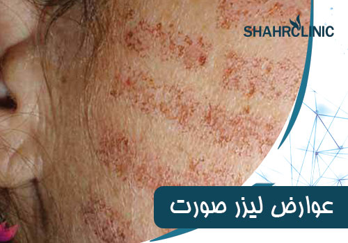 عوارض لیزر صورت زنان و مردان