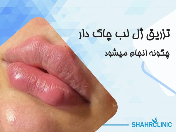 تزریق لب چاک دار