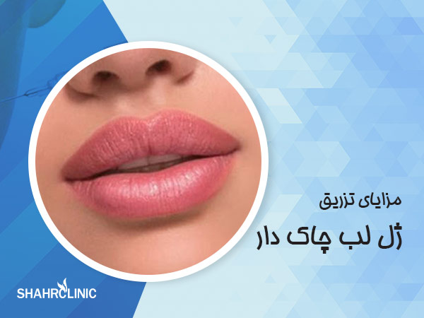 مزایای تزریق ژل لب چاکدار