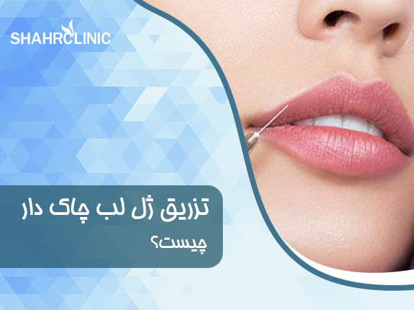 تزریق ژل لب چاک چیست