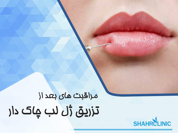 مراقبتهای بعد از تزریق ژل لب چاکدار