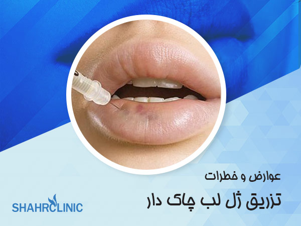 عوارض و خطرات تزریق ژل لب چاک دار