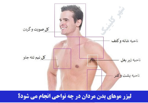 لیزر موهای بدن مردان در چه نواحی از بدن صورت میگیرد؟