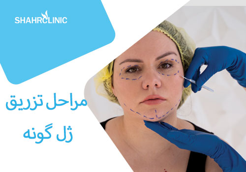 مراحل تزریق ژل گونه‌ به چه صورت است؟