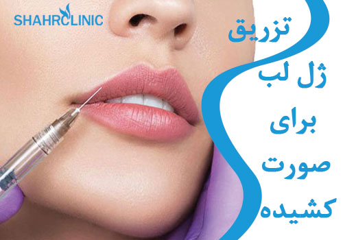 تزریق ژل لب برای صورت کشیده