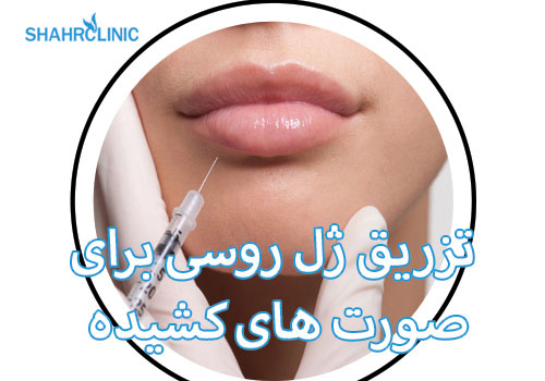 تزریق ژل روسی برای صورت کشیده