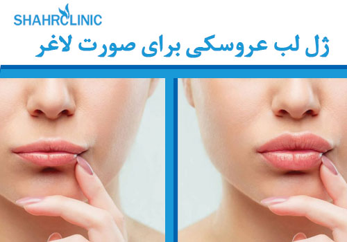 ژل لب عروسکی برای صورت لاغر