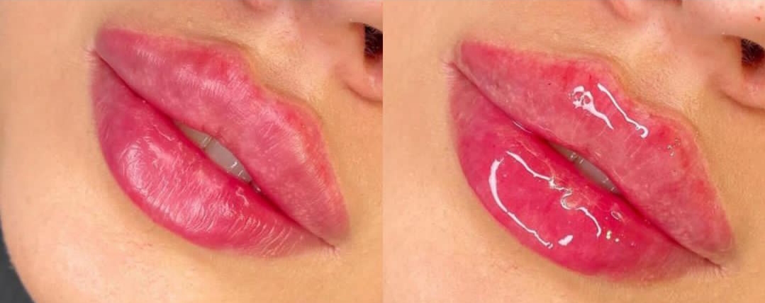 تصویر ژل لب چاکدار در نیاوران