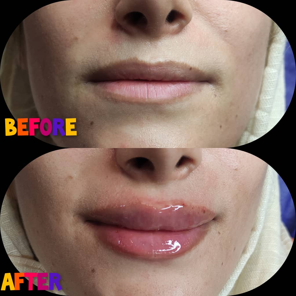 تصویر تزریق ژل لب در باغ ملک خوزستان