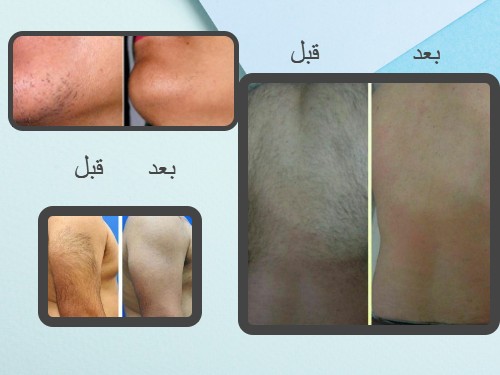 تصویر لیزر کل بدن در سنندج