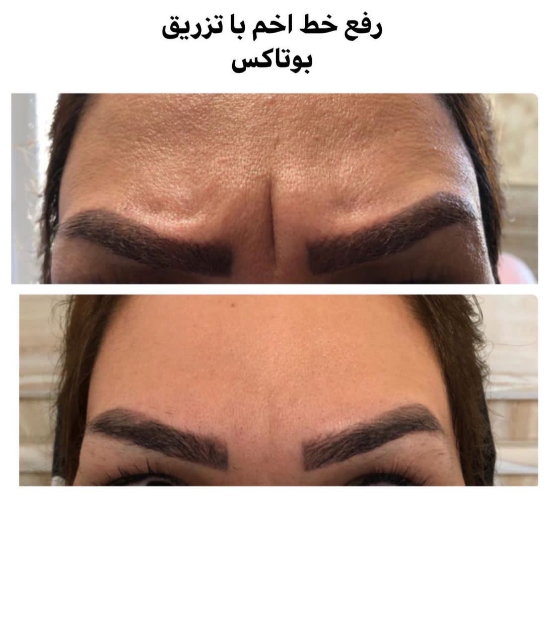 تصویر تزریق بوتاکس صورت اردبیل