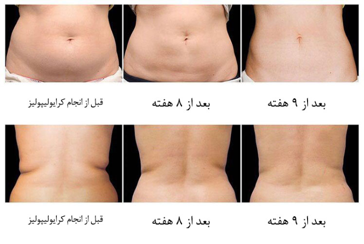 تصویر درمان چاقی و از بین بردن چربی در تبریز