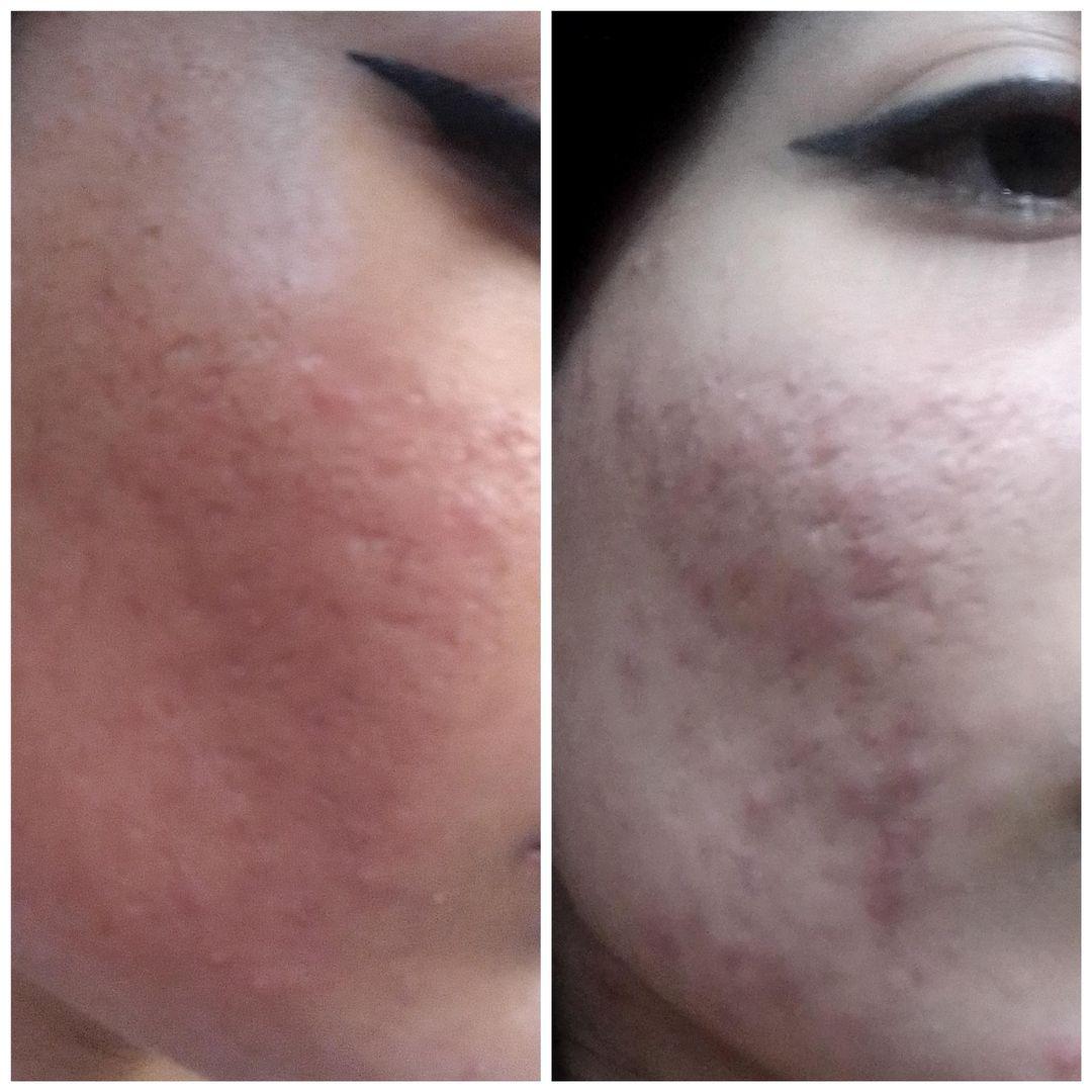 تصویر پاکسازی صورت در مشهد با دستگاه