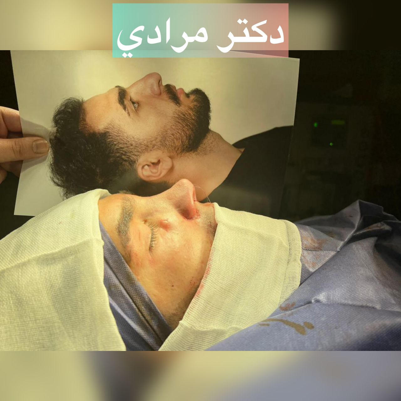 تصویر جراحی بینی توسط دکتر مرادی