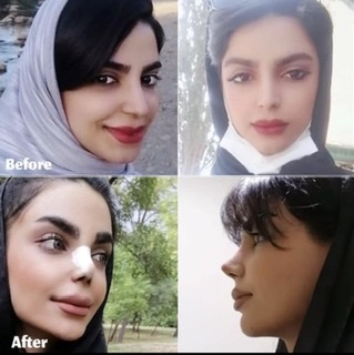 تصویر فرم جراحی بینی در مشهد