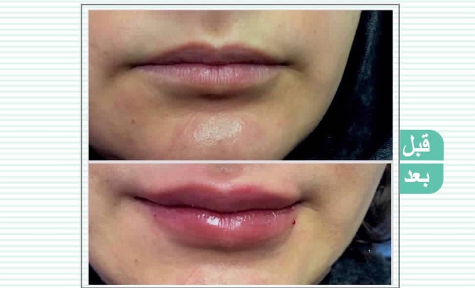 تصویر مادلینگ صورت در قم