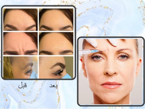 تصویر تزریق بوتاکس سنندج